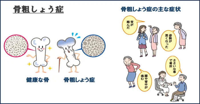 骨粗しょう症について