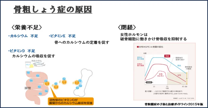 骨粗しょう症について